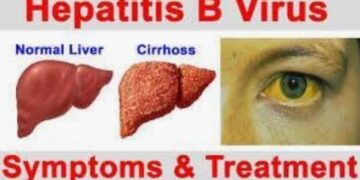 HEPATITIS B AND C  – DIAGNOSIS AND SOLUTION